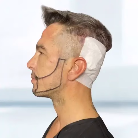 Barttransplantation Türkei 3 Barttransplantation Türkei – Mann mit vollem, dichtem Bart nach erfolgreicher Bart-OP. Das Bild zeigt das natürliche Ergebnis einer professionellen Barttransplantation in der Türkei für ein gepflegtes, maskulines Erscheinungsbild