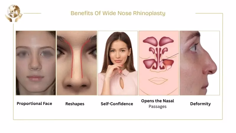 Wide Nasal Bone Reduction: What to Expect Before and After 2 Benefits Of Wide Nose Rhinoplasty