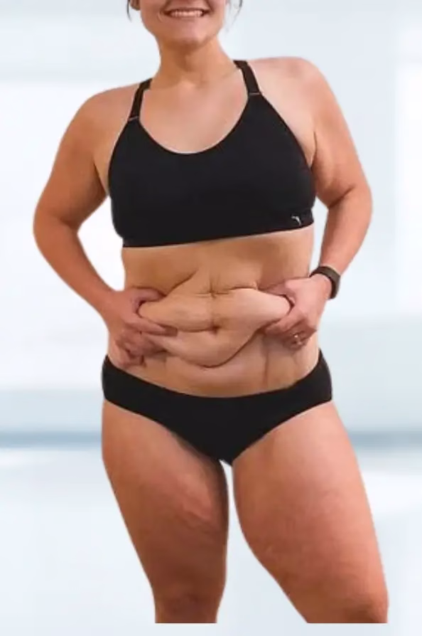 Best Candidates for Liposuction Procedure