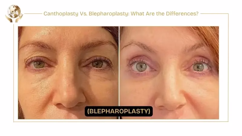 Blepharoplasty
