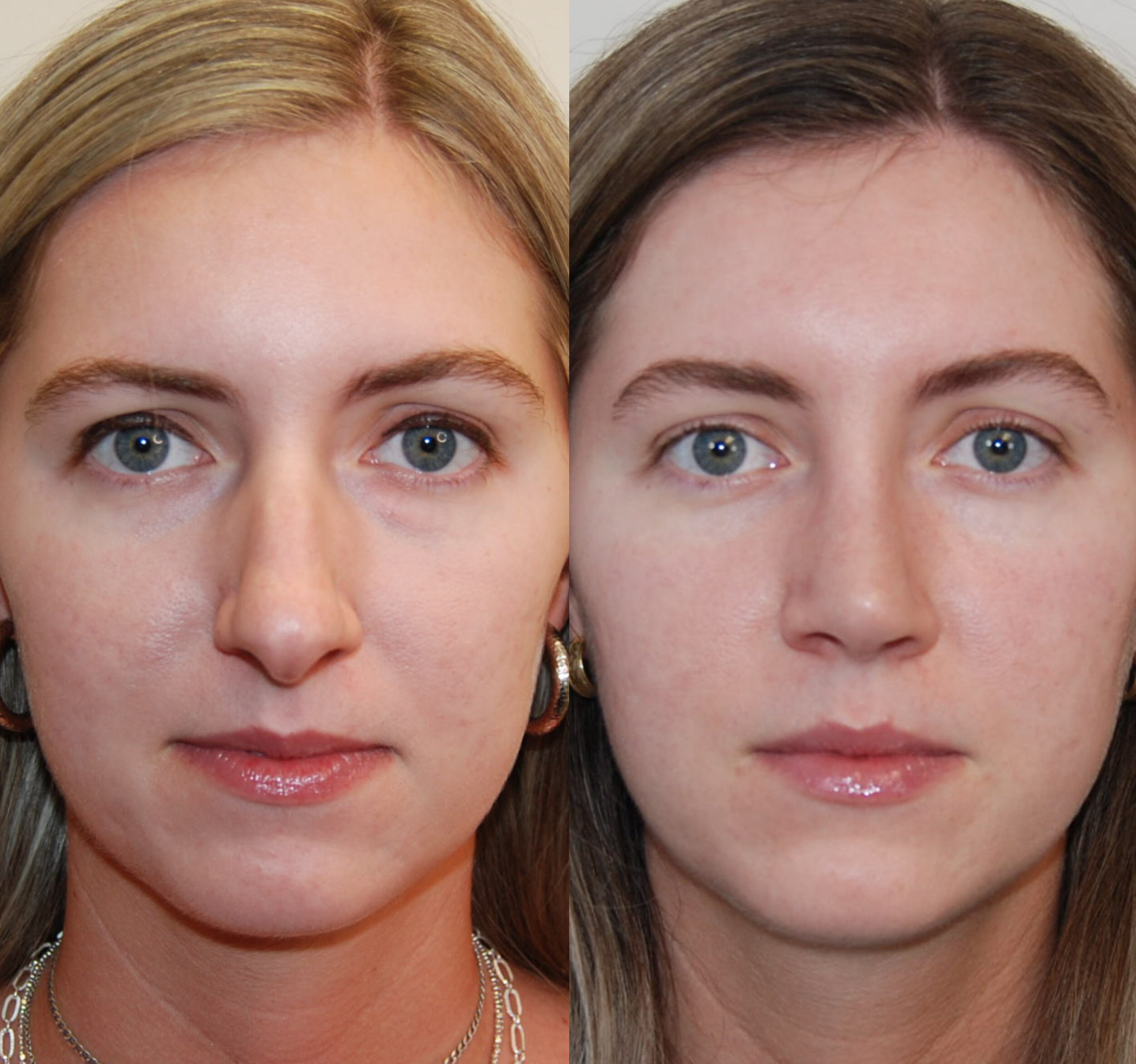 Blepharoplasty in Turkey 3 Blepharoplasty in Turkey