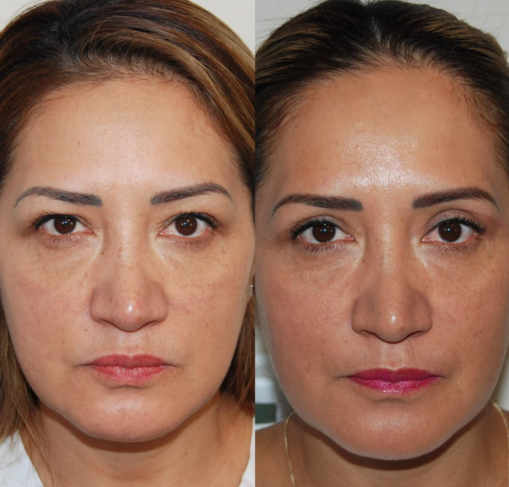 Blepharoplasty in Turkey 4 Blepharoplasty in Turkey before and after