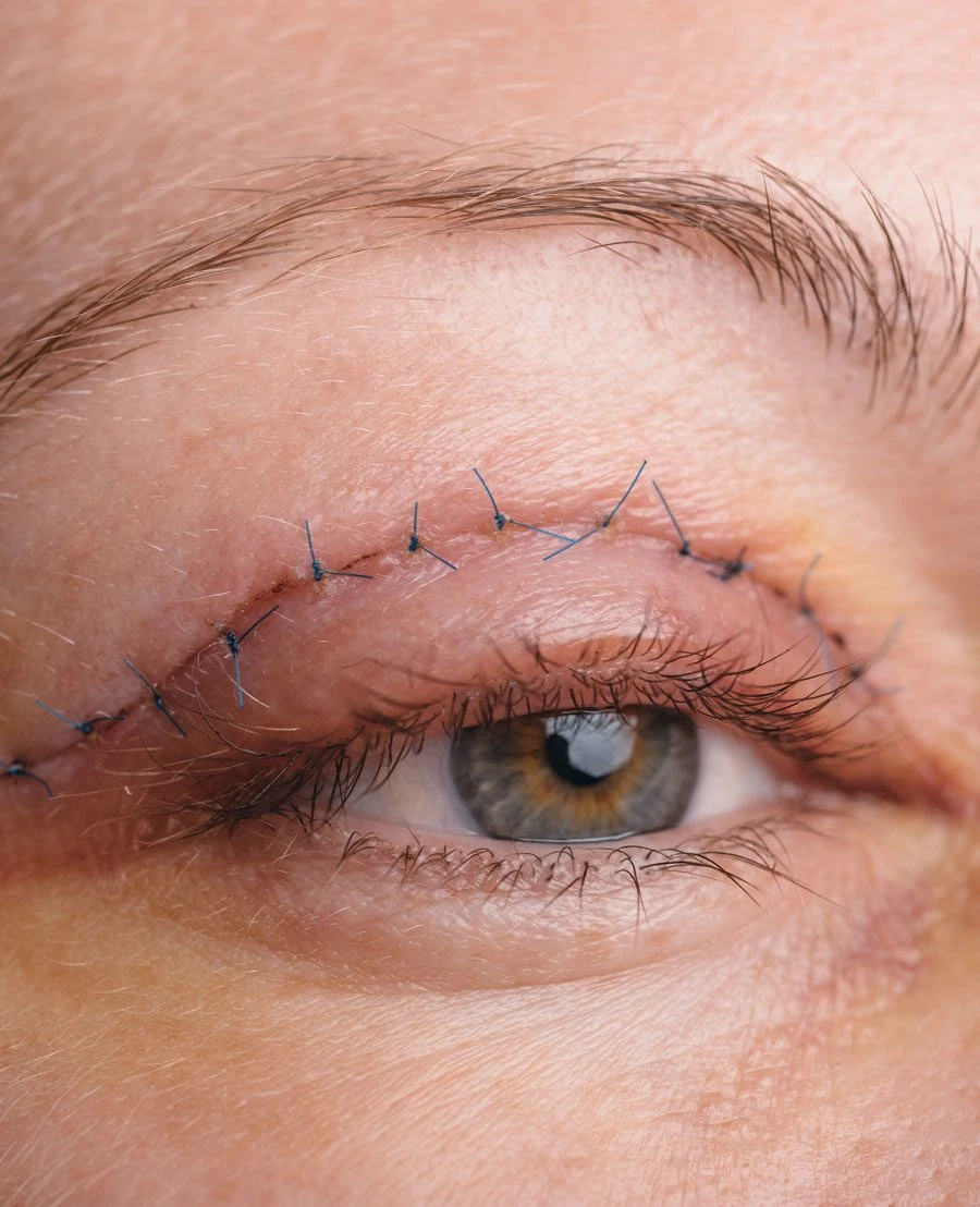 Blepharoplasty in Turkey 2 Blepharoplasty in Turkey