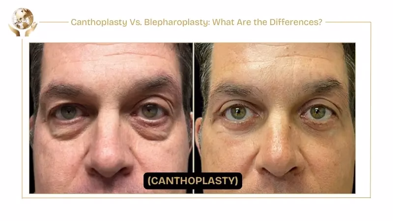 Canthoplasty Vs. Blepharoplasty What Are the Differences