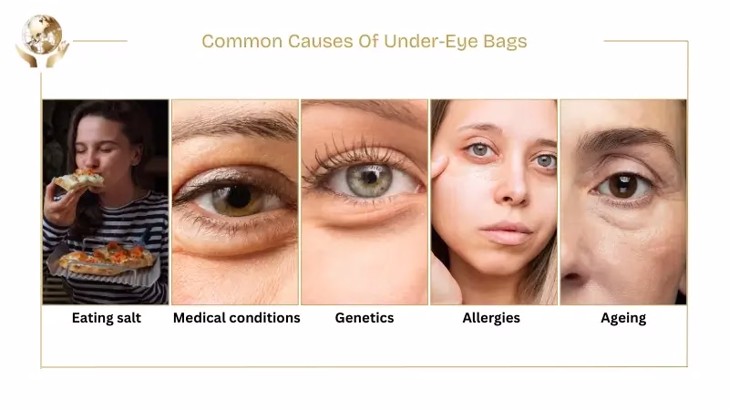 Common Causes Of Under-Eye Bags