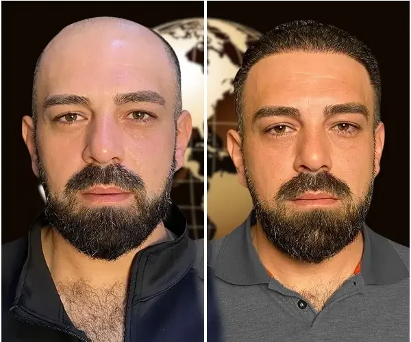 DHI-hair-transplant-turkey-before-and-after