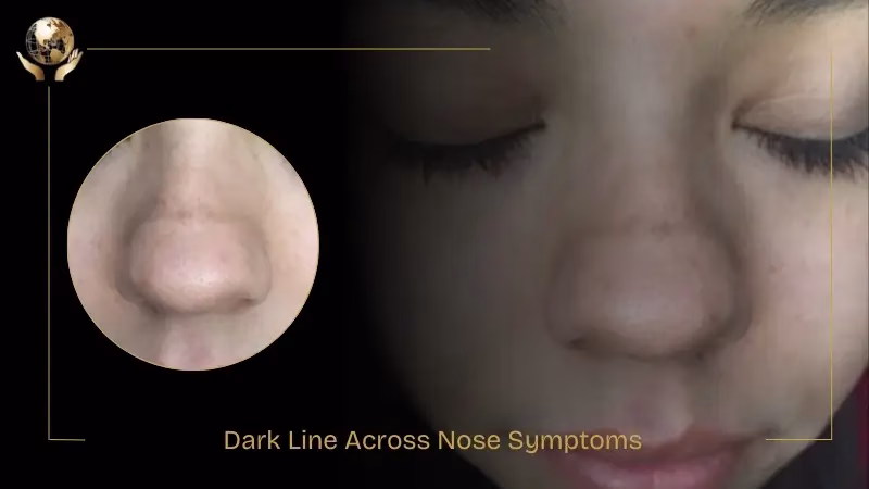 How to Treat a Transverse Nasal Crease: Creams to Lasers 1 Dark Line Across Nose Symptoms