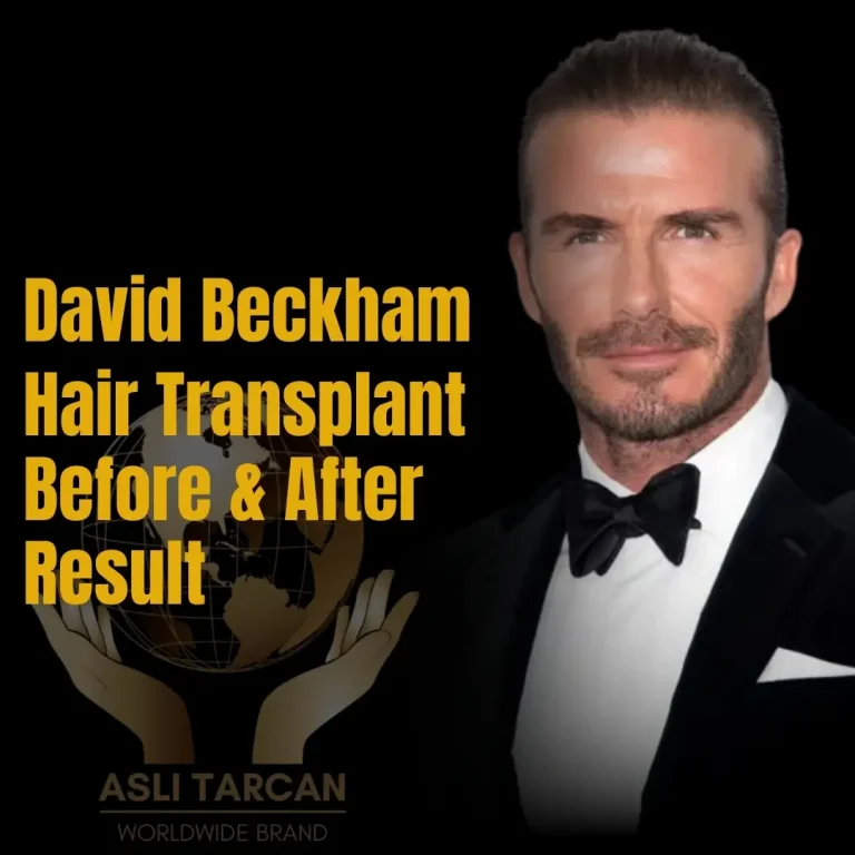 David Beckham Hair Transplant