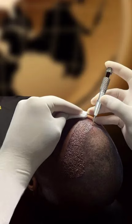 Spezialist implantiert Haarfollikel bei DHI-Haartransplantation für natürliches Ergebnis