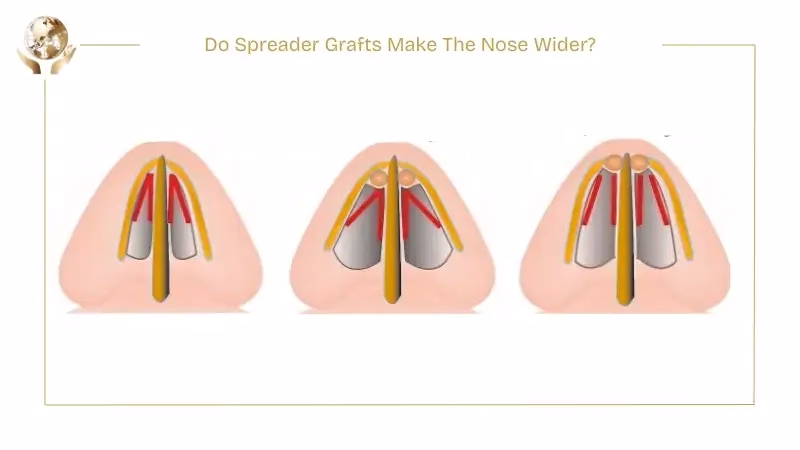 Do Spreader Grafts Make Nose Wider or Fix the Inverted-V? 3 Do Spreader Grafts Make The Nose Wider
