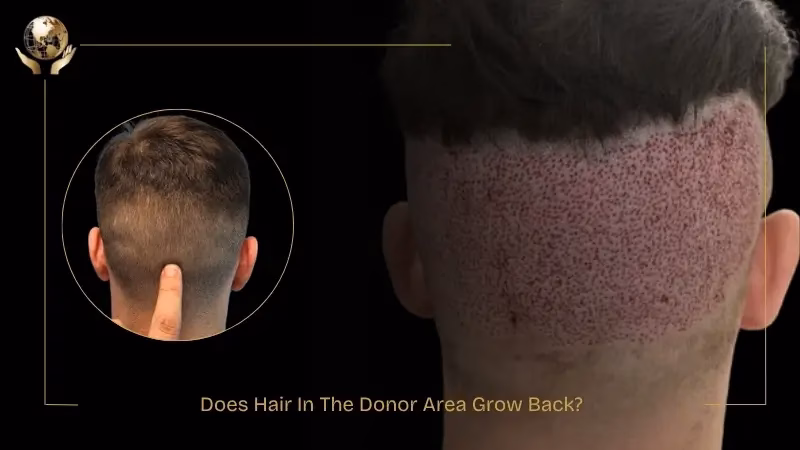 Not Enough Donor Hair For Transplant 10 Does Hair In The Donor Area Grow Back