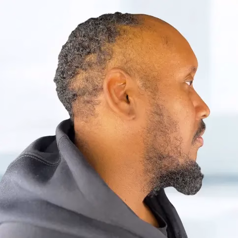 Paciente mostrando el resultado del injerto de barba y restauración capilar, con mejora visible en las zonas tratadas después del procedimiento.