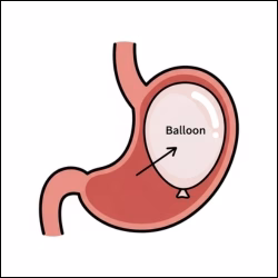 Gastric Balloon