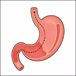 Gastric Sleeve