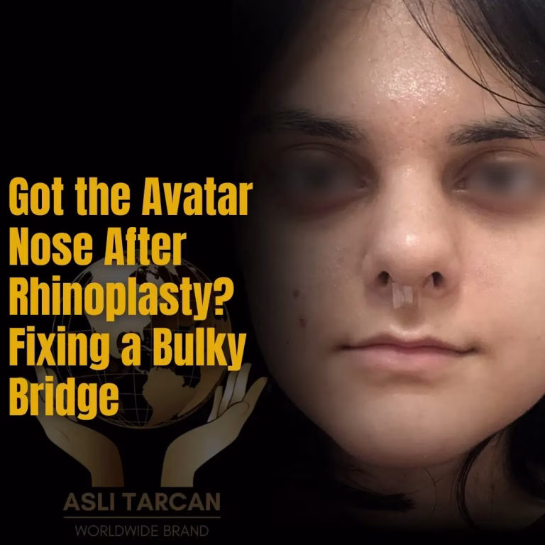Got the Avatar Nose After Rhinoplasty Fixing a Bulky Bridge