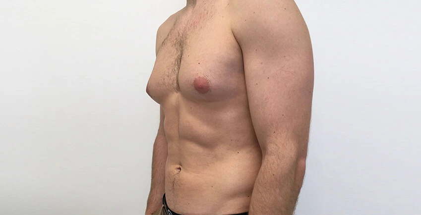 4 Gynecomastia Surgery Turkey