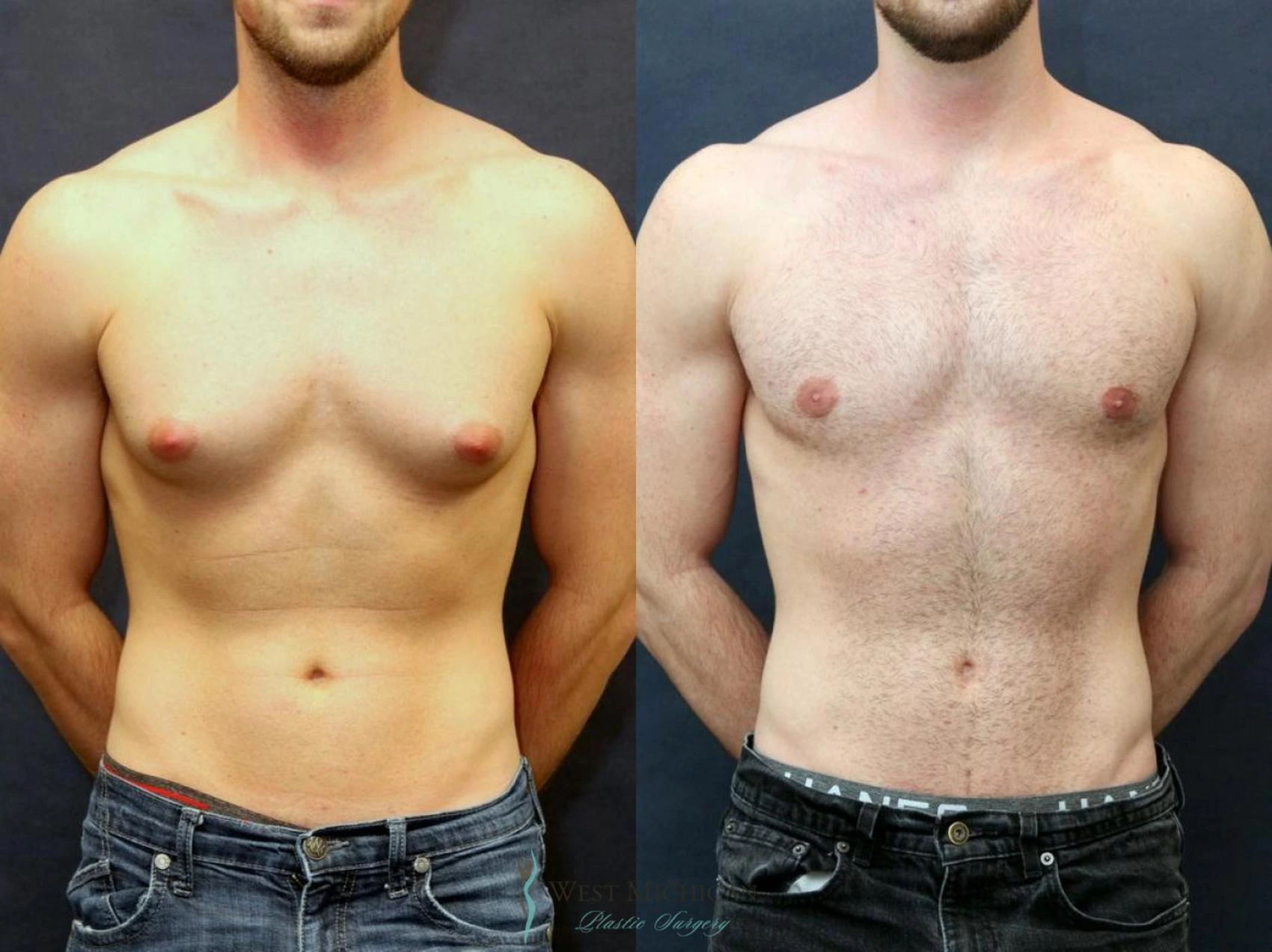 1 Gynecomastia Surgery in Turkey