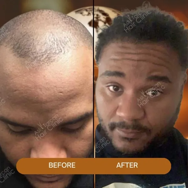 afro hair transplant,Afro Hair Transplant turkey,afro hair transplant in Turkey