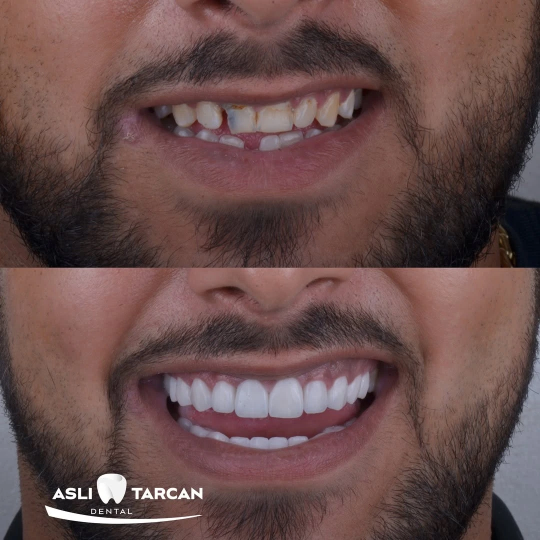 Hollywood Smile