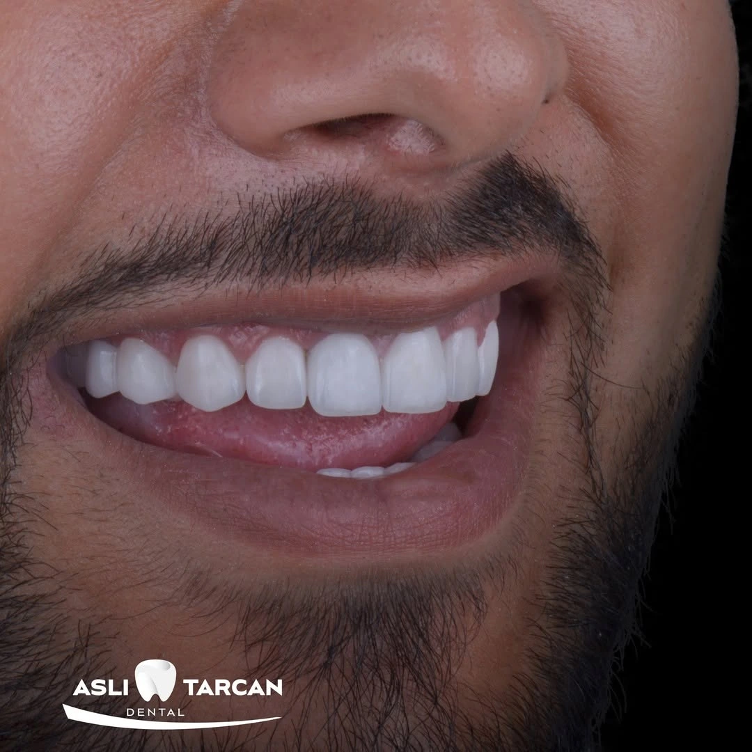 Hollywood Smile Makeover