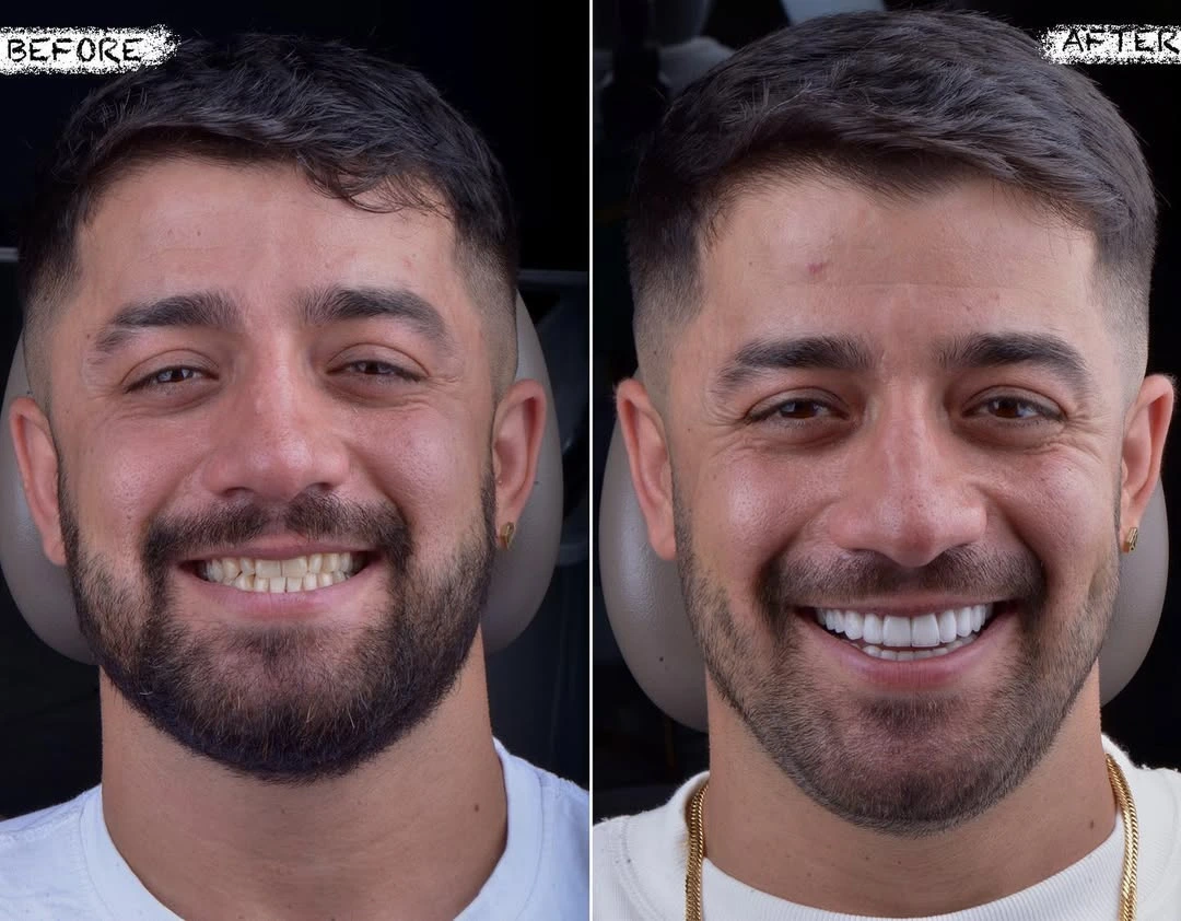 Hollywood Smile Turkey