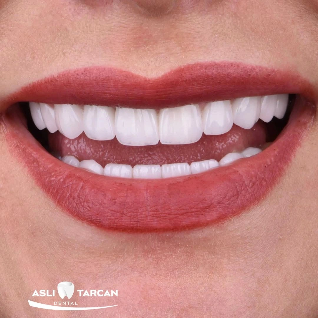 How Long Does Hollywood Smile Last1