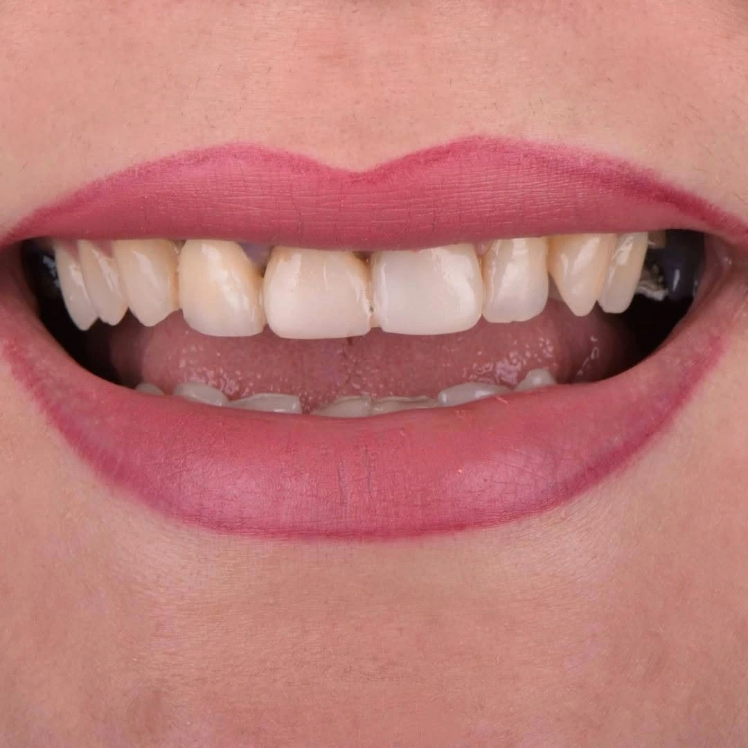 How Long Does Hollywood Smile Last2