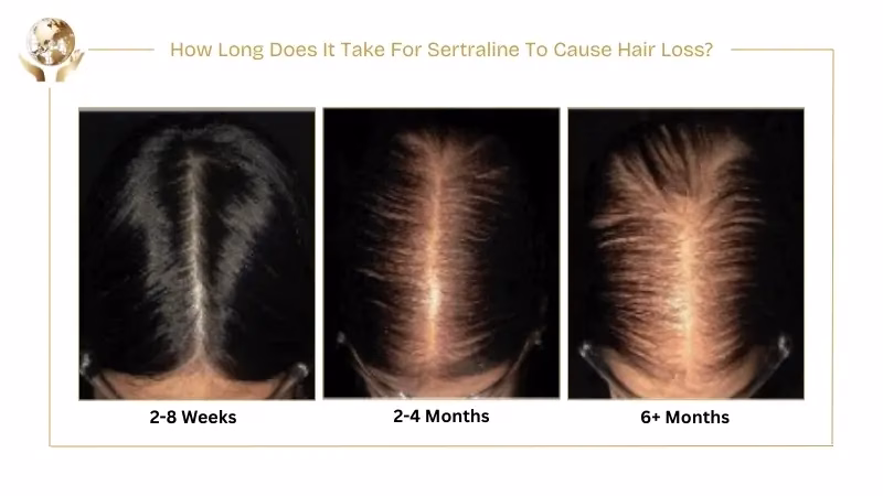 Can Sertraline Cause Hair Loss? Symptoms & Reversal Tips 5 How Long Does It Take For Sertraline To Cause Hair Loss