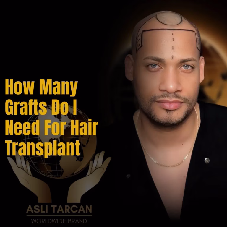 How Many Grafts Do I Need For Hair Transplant