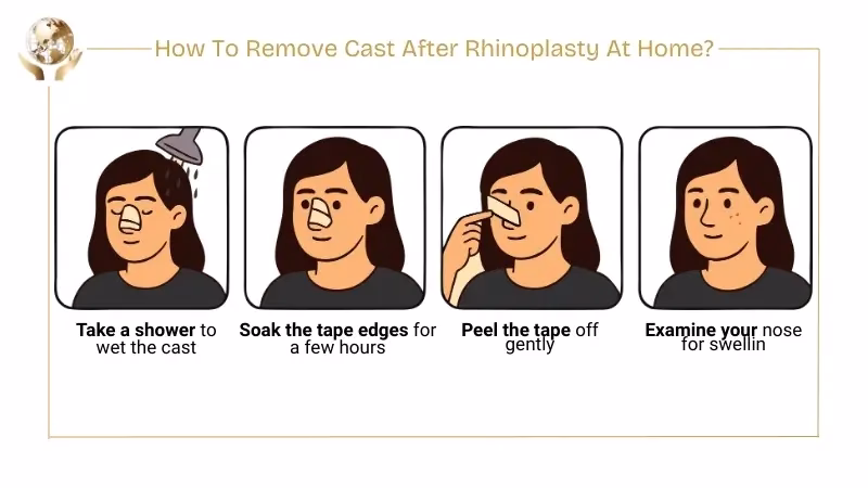 Why Do You Have To Wear Cast After Rhinoplasty? 5 How To Remove Cast After Rhinoplasty At Home