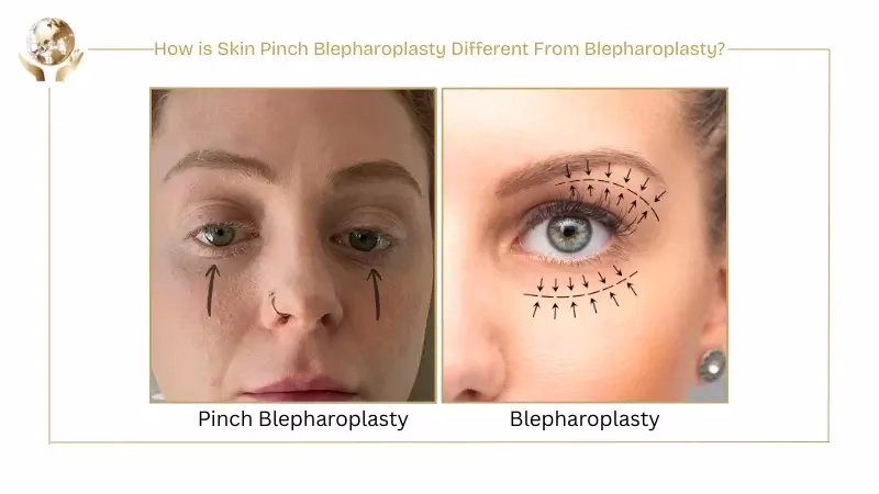 How is Skin Pinch Blepharoplasty Different From Blepharoplasty