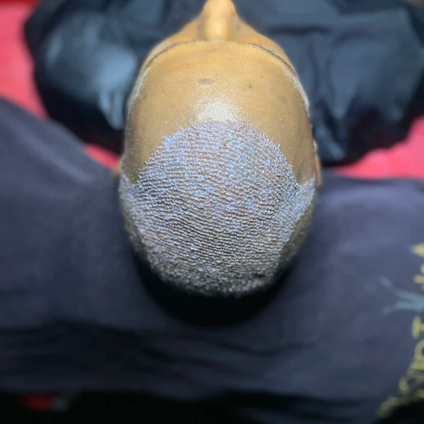 afro hair transplant,Afro Hair Transplant turkey,afro hair transplant in Turkey