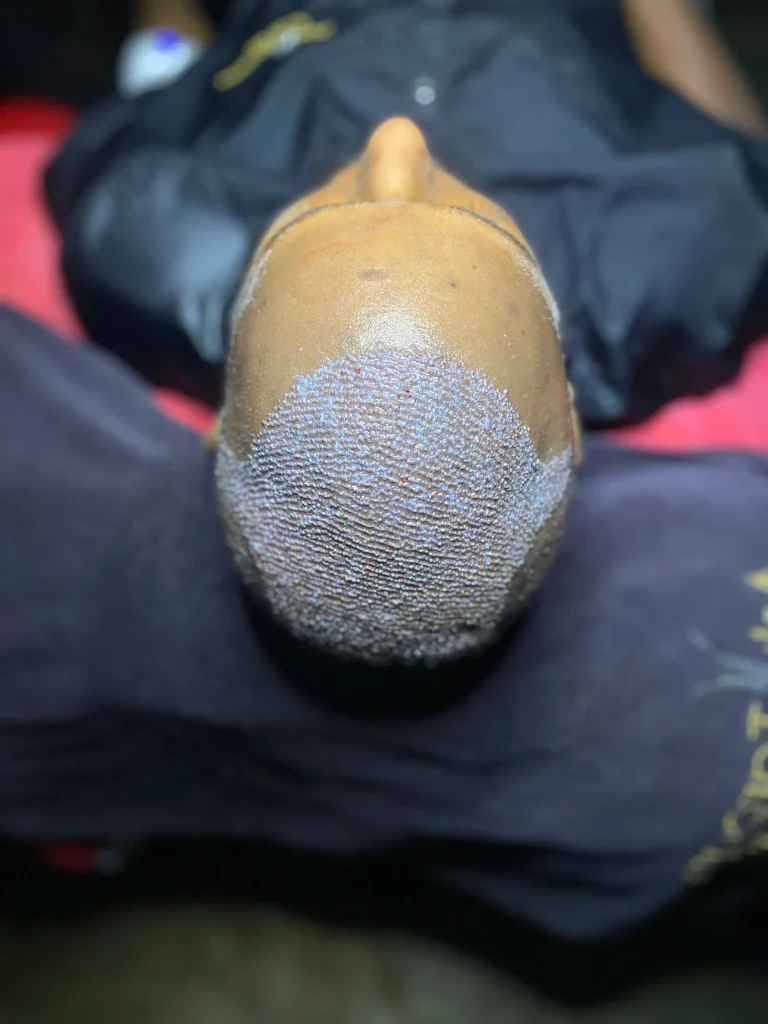 Afro hair transplant grafting