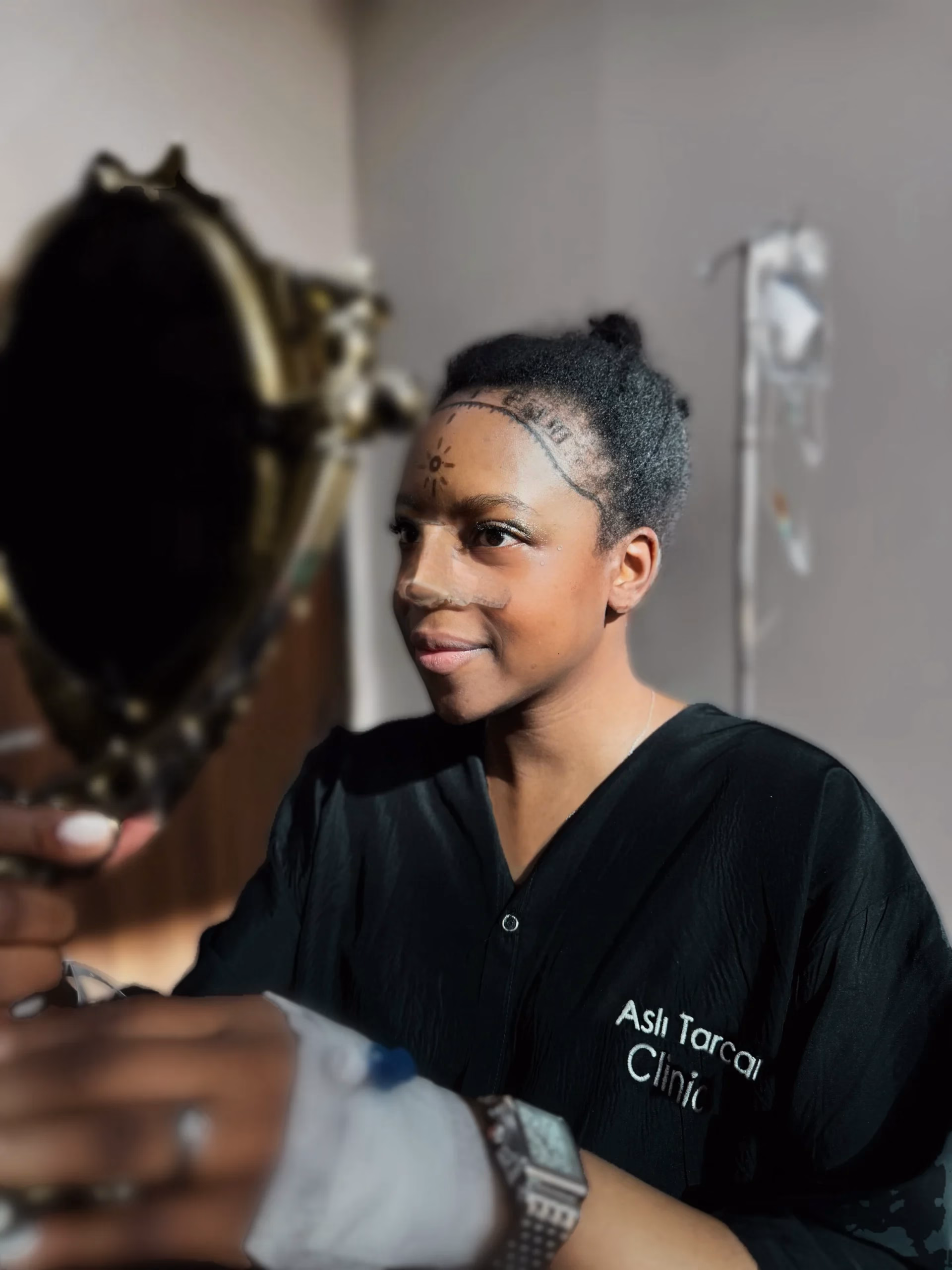 Persona con cabello afro mirándose en un espejo en una clínica, con la línea del cabello marcada tras un procedimiento de injerto capilar afro.