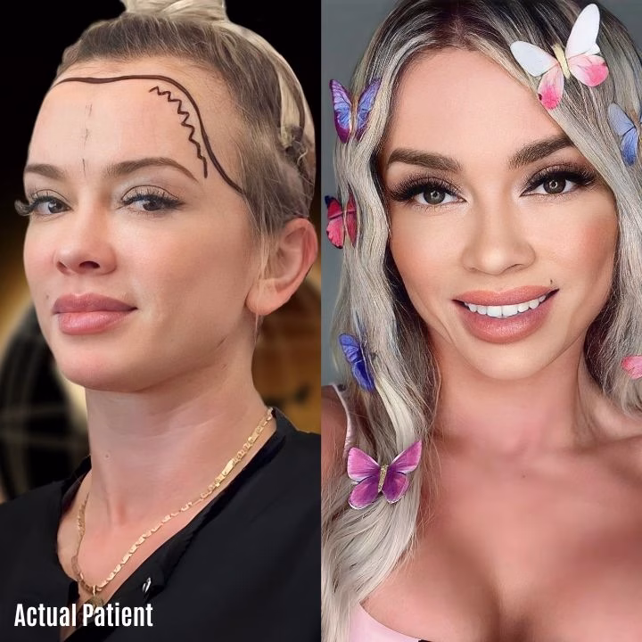 Antes y después de injerto capilar mujer: a la izquierda planificación del tratamiento, a la derecha resultado con cabello más lleno y estilizado.