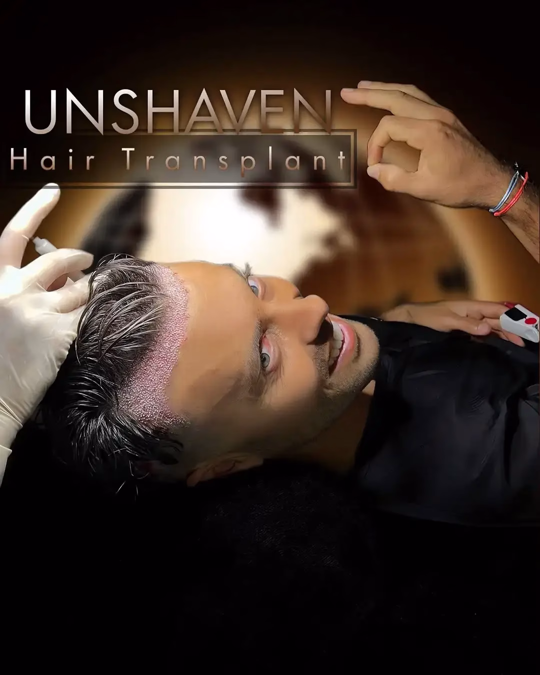 Persona recostada sonriendo mientras recibe un procedimiento médico en la línea frontal del cabello, con microinjertos visibles y el pelo sin rasurar; una mano con guantes trabaja en la zona tratada bajo un entorno clínico, destacando el concepto de injerto capilar sin rapar.