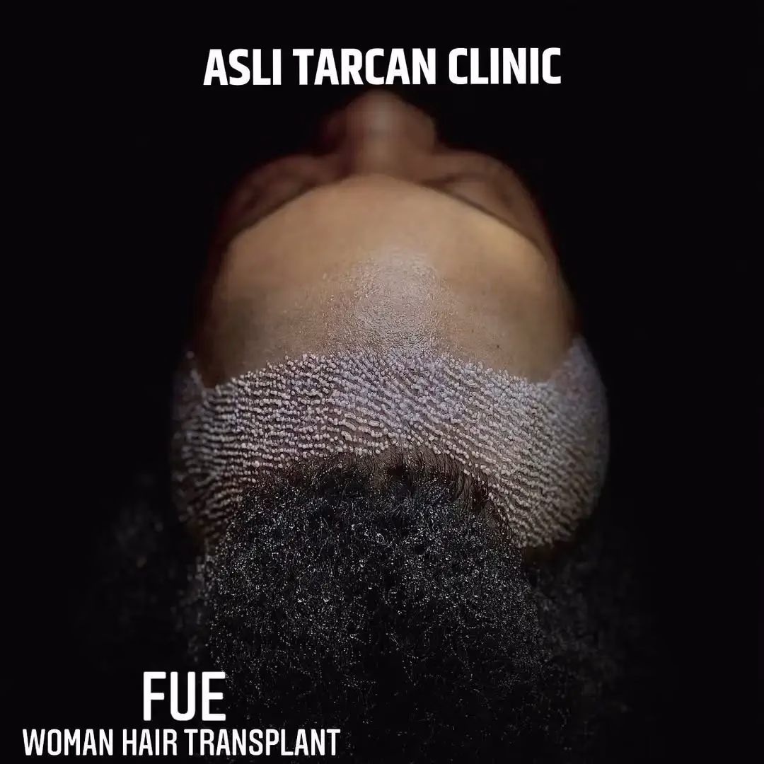 Persona acostada boca arriba, enfocada en la frente y línea capilar con numerosos microinjertos recién colocados en la zona frontal, mostrando el resultado inmediato de una técnica FUE en la clínica; el cabello natural permanece largo y sin rasurar, destacando el procedimiento de injerto capilar sin rapar.