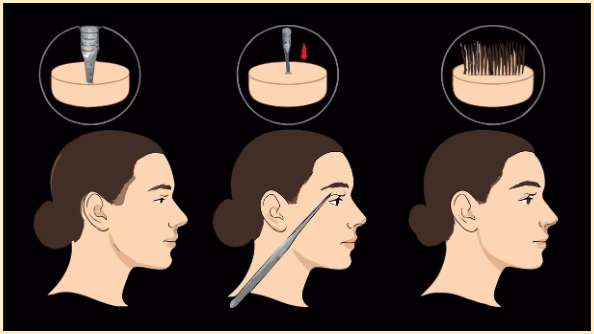 Ilustración que muestra el proceso de un injerto de cejas paso a paso: extracción del folículo piloso, implantación en la zona de las cejas y resultado final con cejas más densas y definidas.