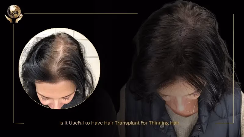 Hair Transplant for Thin Hair: Causes, Procedure & Benefits 3 Is It Useful to Have Hair Transplant for Thinning Hair