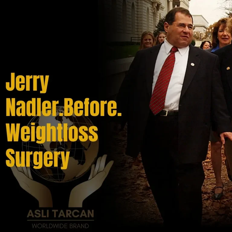 Jerry Nadler Before Weight loss Surgery