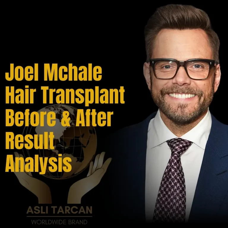 Joel Mchale Hair Transplant