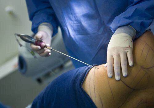 Liposuction Surgery in Turkey 9 Liposuction turkey