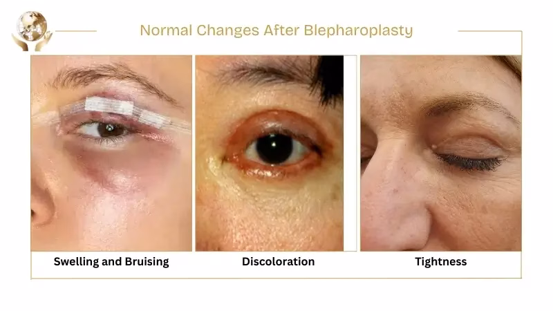 Normal Changes After Blepharoplasty