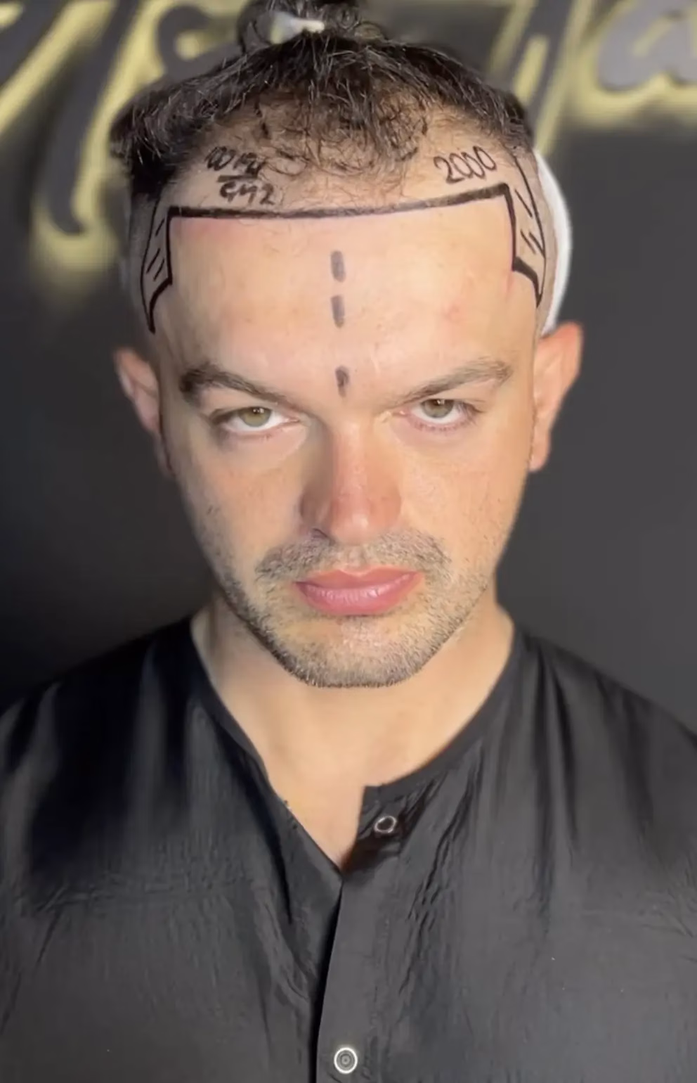 Hombre joven mirando al frente con líneas de marcación en la frente y los lados de la cabeza, preparándose para un procedimiento de trasplante capilar en una clínica especializada.