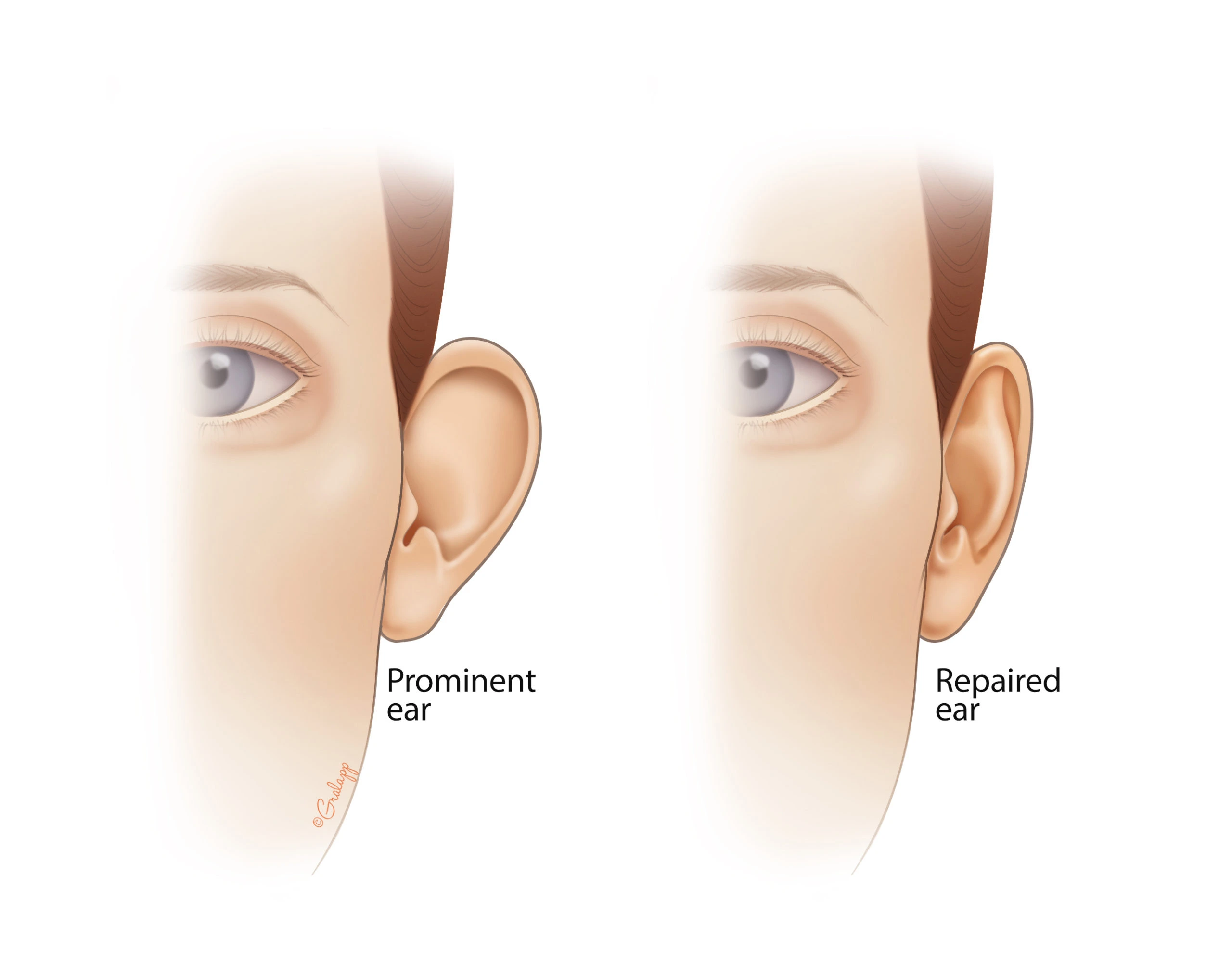 1 Otoplasty in Turkey
