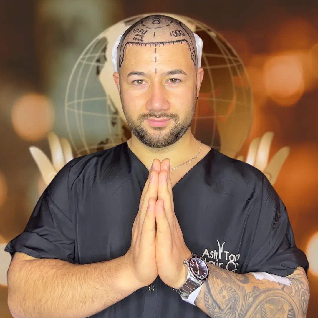 Hair Transplant Before & After