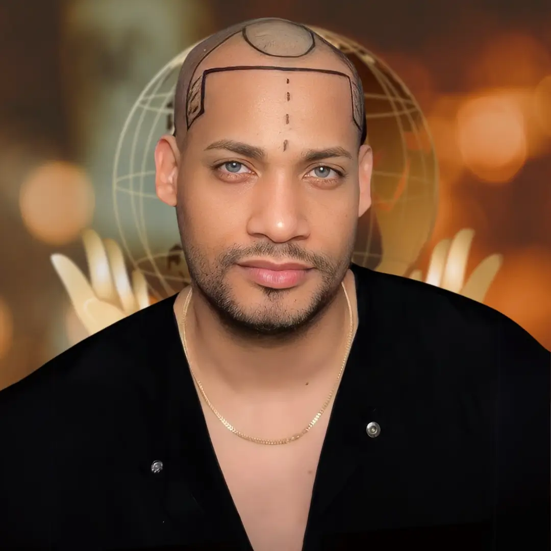 Hair Transplant Before & After