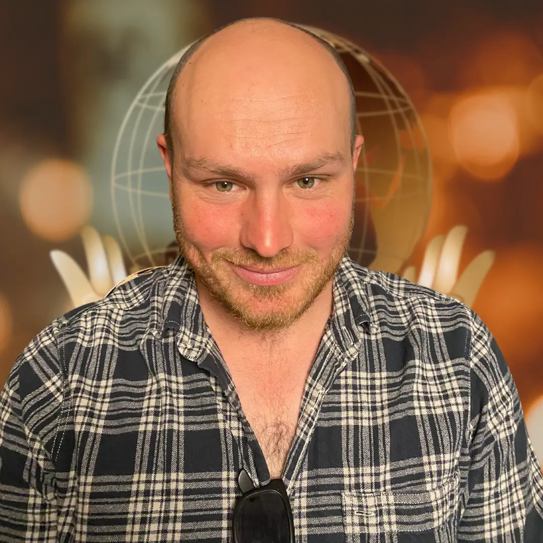 Hair Transplant Before & After