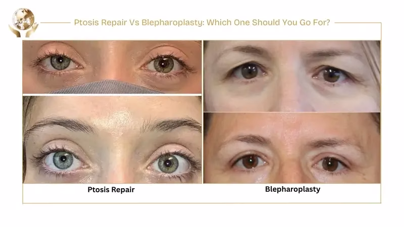 Ptosis Repair Vs Blepharoplasty Which One Should You Go For