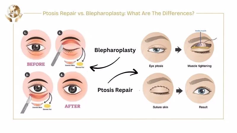 Ptosis Repair vs. Blepharoplasty What Are The Differences